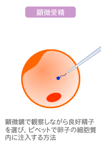 顕微授精は顕微鏡下で卵子の細胞に精子を注入する治療法 イメージ画像